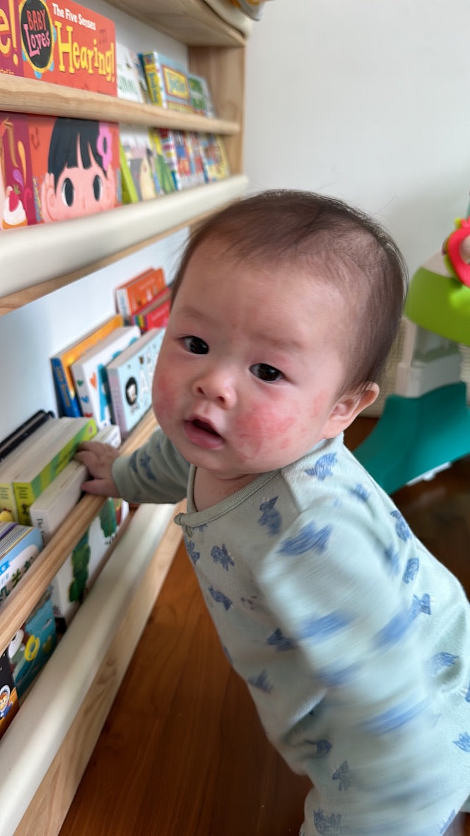 From Heartbreak to Healing: My Journey with Hae In’s Eczema